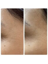 リラクゼーションビューティーハウス カヤ(kaya)/V3ピンジェクトセラムの使用感