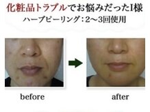 EMI 上野店/＃お肌をきれいにしたい