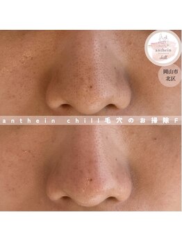 アンテイン チル(anthein chill)/毛穴のお掃除フェイシャル