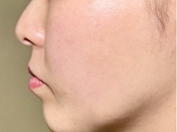 ピレア(Pillea)の写真/【本気の肌質改善☆】ヒト幹細胞培養液原液１００％を４ｃｃ使用し深部へアプローチ！エイジングケアにも◎