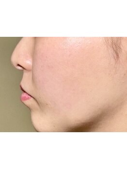 ホウレイ線・たるみ改善！予防ケア