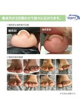 スタジオ1108(Studio1108)/巻き爪ケア 巻き爪緩和ジェル