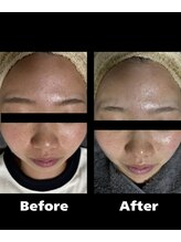 ハーブピーリングHY/トーンアップ、美白！