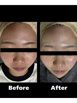 ハーブピーリングHY/トーンアップ、美白!