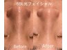 初回55％OFF！【全てのお肌悩みを改善】 BBL光フェイシャル¥14,080⇒¥6,380