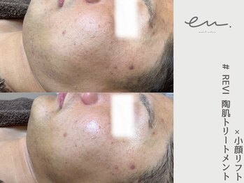 エム(eM.)/メンズ小顔リフト1回施術