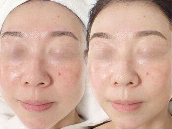 レイネ(REINE)/韓国肌管理★ララピール