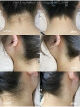 エムズスタイル ネイルバー(M's Style NAIL BAR)/うなじ脱毛