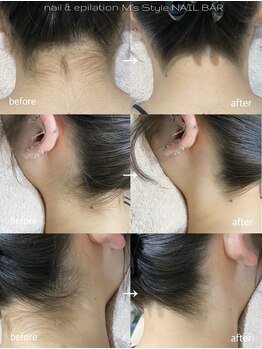 エムズスタイル ネイルバー(M's Style NAIL BAR)/うなじ脱毛