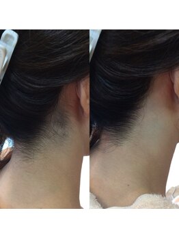 美容整体サロン 心斎橋/襟足シェービング