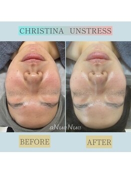 アヌエヌエ(aNueNue)/アンストレス症例《赤ら》