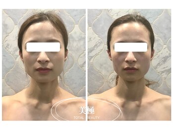 美極 銀座店/銀座/小顔コルギ/小顔矯正