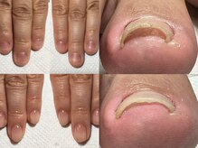 カンパニュラ(Campanula)/自爪育成３か月後巻き爪ケア１回