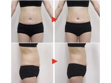 プレジール(PLAISIR)/キャビテーション腹部・ウエスト