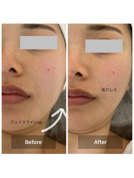 ルミエール(Lumiere)/２０代　EMSでリフトアップ☆