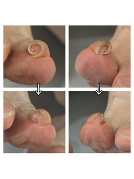 エムスラッシュ ネイル センター北店(M.SLASH)/巻き爪ケア フットケア