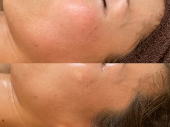 ビジュープラス 広島店(Bijou+)/【30代/赤ら顔】