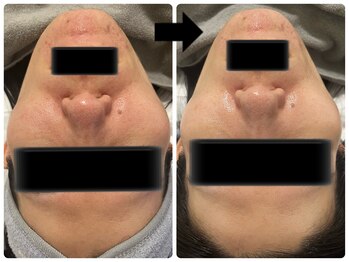 エフェクト 塚口店(effect)/Before After 30代/1回目