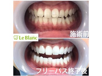ルブラン 奈良店(Le Blanc)/綺麗な歯を!