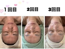 ルーチェ(LUCE)/小顔リフトUP/小顔矯正/筋膜