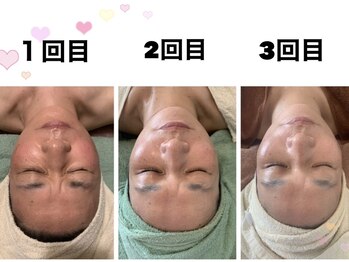 ルーチェ(LUCE)/小顔リフトUP/小顔矯正/筋膜