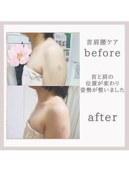 アリサナ(Arisana)/症例写真　肩甲骨はがし