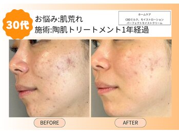 ムーンサン(Moon sun)/30代陶肌トリートメントリピート