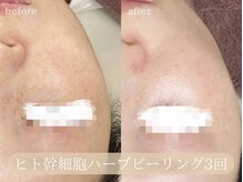 ハジュ(HAJU.)の雰囲気（施術前後でしっかりカウンセリングをさせて頂きます♪毛穴/脱毛）
