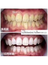 ホワイトニングサロン 京都烏丸店/ホワイトニング施術例