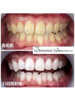 ホワイトニングサロン 京都烏丸店/ホワイトニング施術例