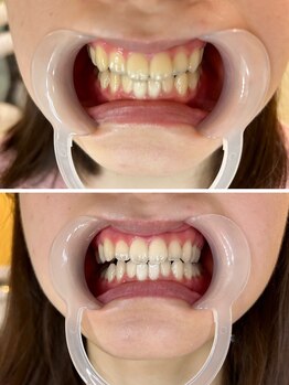 ホワイティアビシェル 浦和(Whitia Vishell)/セルフホワイトニング高出力