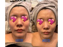 プライム(Prime)/ハーブピーリング