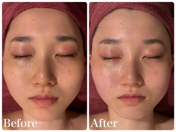 エステティック レイビス 青森店(RAYVIS)/劇的!?小顔フェイシャル!