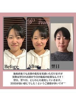 ピオニー(Peony)/Before & After