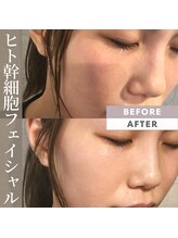 サンテボーテ(Sante Beaute)/【ヒト幹細胞フェイシャル2回】