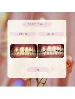 プラスビーセルフ(+b self)/ホワイトニングビフォーアフター