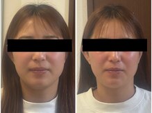 セルビューティー(Cell Beauty)/20代、お顔の筋膜リリース3回