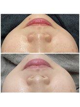 沖 野上鍼灸整骨院/毛穴洗浄