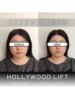 ブリリオプラス 広島並木店(Brillio Plus)/2000ショット+プラズマシャワー