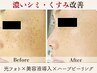 【シミ、くすみ、ほうれい線】】毛穴洗浄×光フェイシャル×ヒト幹細胞導入