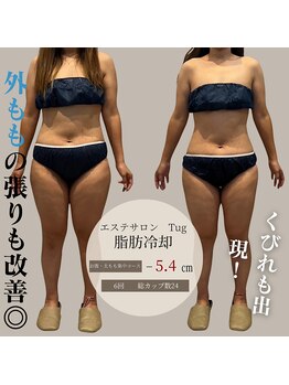 タグ 高知駅前店(Tug)/脂肪冷却