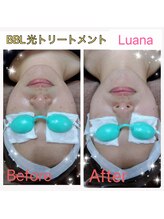 ルアナ(Luana)/BBL光トリートメント