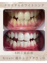 キラット 越谷レイクタウン店(Kiratt)/ビフォーアフター　2