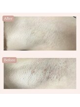 リードエピア(LEADepiA)/ワキ脱毛６回目