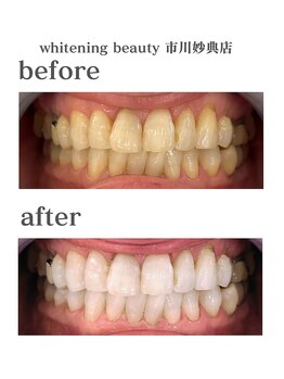ホワイトニングビューティー 市川妙典店/歯科提携/ホワイトニング/妙典