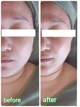 ニワ(Niwa)/バザルトフェイシャル施術例