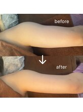 セリーヌ(serene)/キャビラジ　before/After