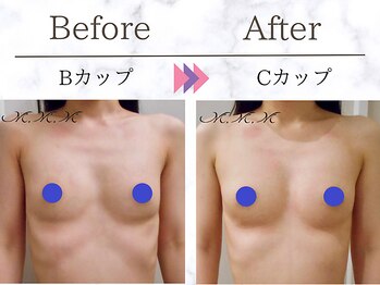 メディカルサロン エム エム エム 心斎橋本店(M.M.M)/【バストアップ例】　B→Cカップ