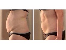 private salon UMIN/脂肪冷却＆電磁パルス痩身