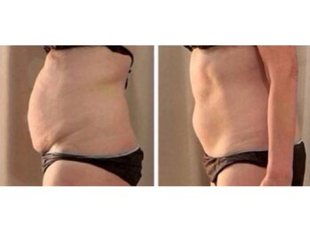 private salon UMIN/脂肪冷却&電磁パルス痩身